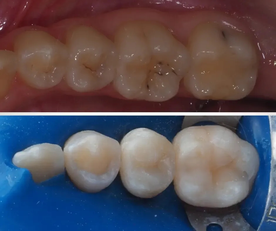 Czy po założeniu plomby można pić alkohol? Ważne informacje dla zdrowia
