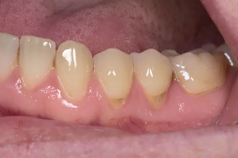 Jak skutecznie leczyć odsłonięte szyjki zębowe i uniknąć bólu – porady i metody